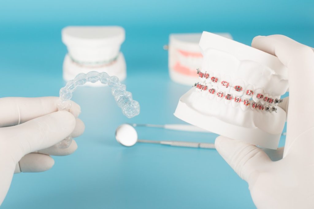 chois d'appareil dentaire | Orthodontie des Laurentides à St Jérôme