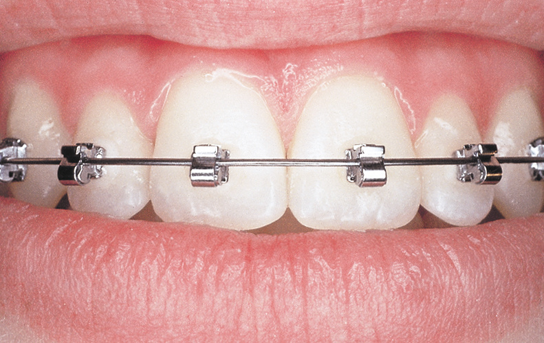 detail bagues dentaires métalliques | Orthodontie des Laurentides à St Jérôme