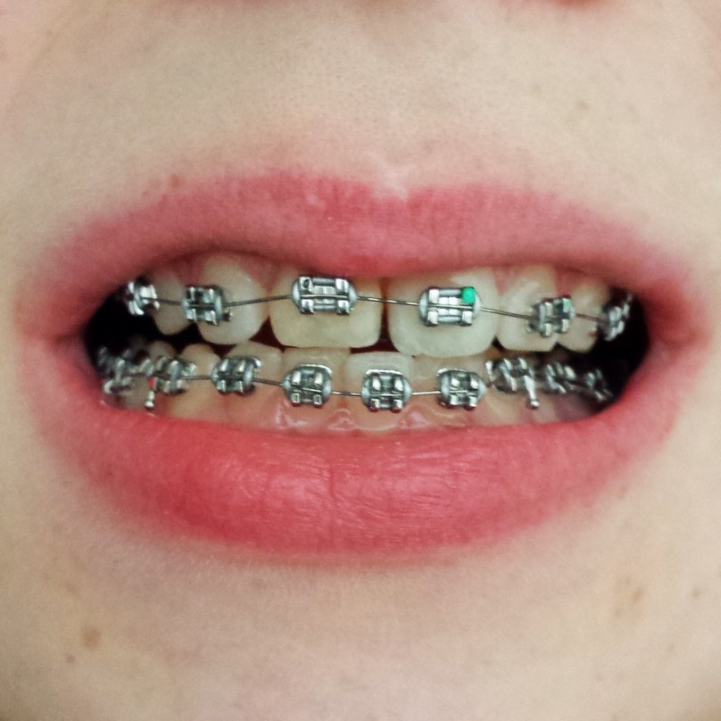 Sourire adolescent avec bagues dentaires| Orthodontie des Laurentides à St Jérôme