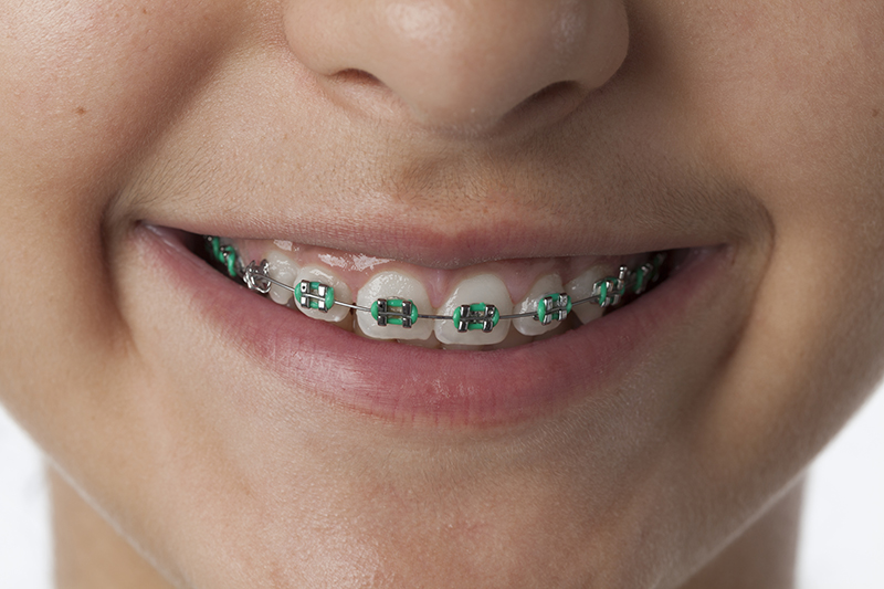 detail bagues dentaires métalliques elastiques | Orthodontie des Laurentides à St Jérôme