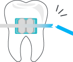 Icône bris d'appareil dentaire | Orthodontie des Laurentides à St Jérôme